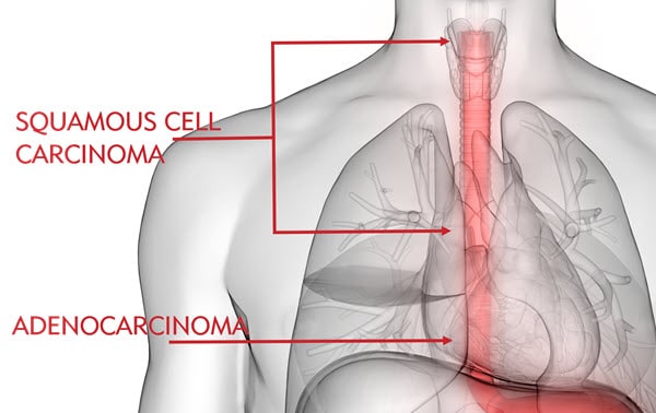 Types of Esophageal Cancer and Where They Occur
