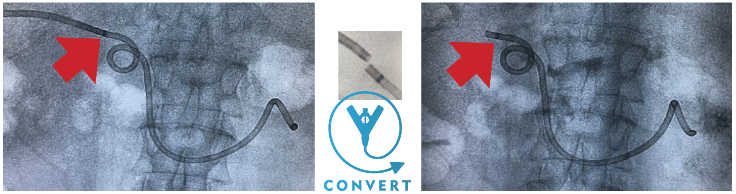 Sample flouro of ReSolve ConvertX Biliary Stent Placement