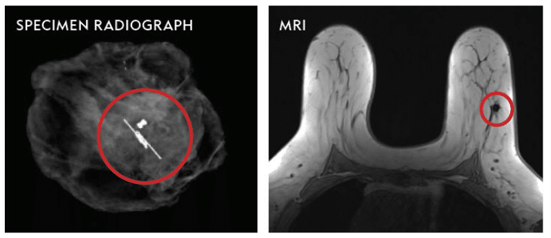 Images of a specimen radiograph and MRI