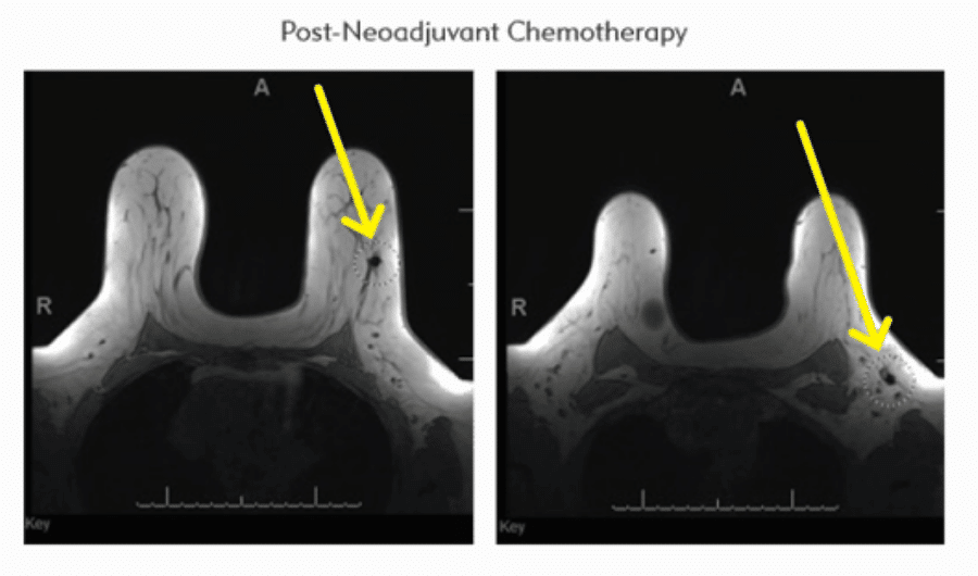 post-neoadjuvant chemotherapy