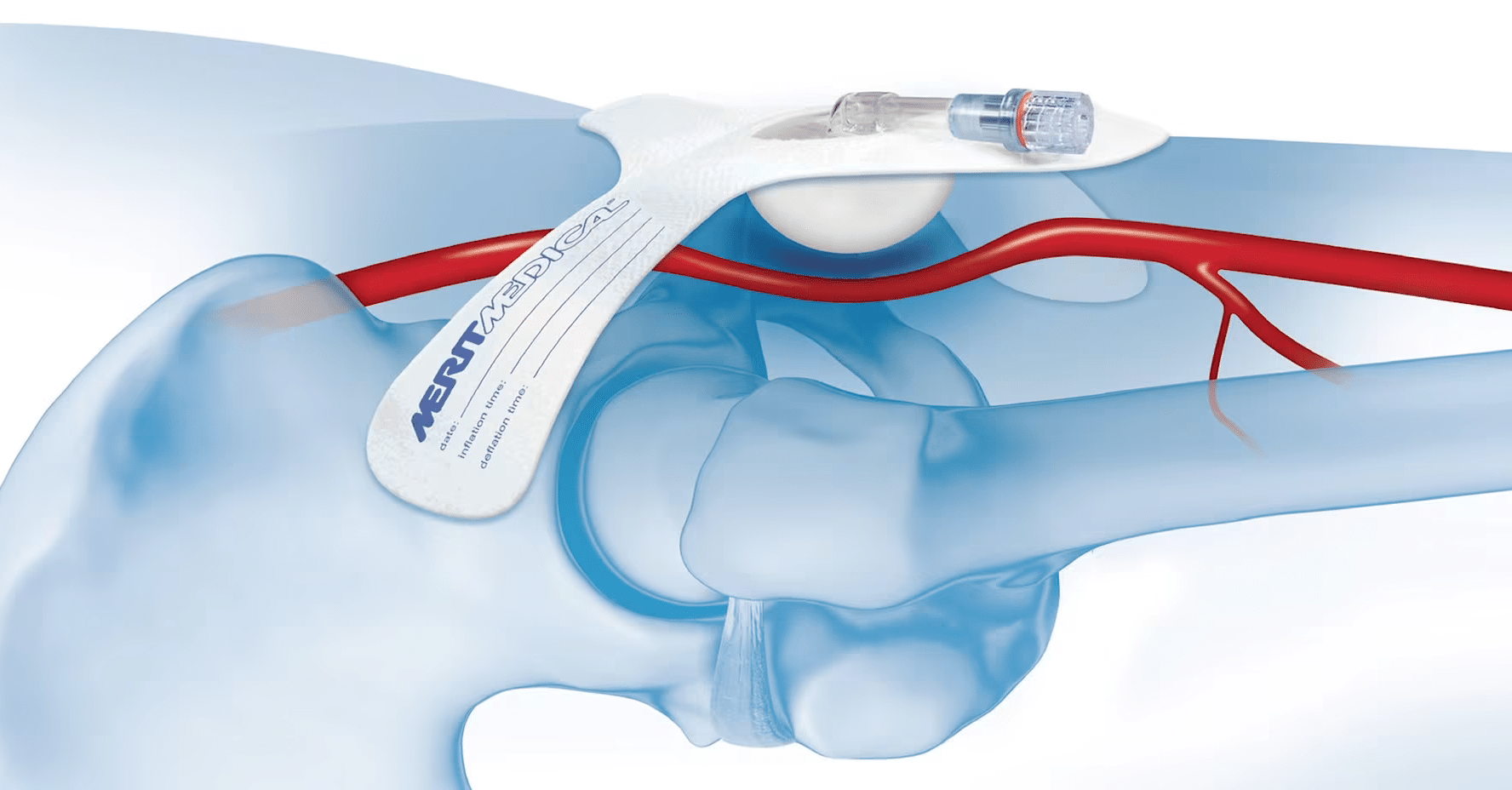 Side view of SafeGuard compression device with view of vein