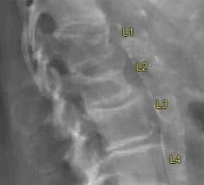 Spinal Fractures L1 & L2