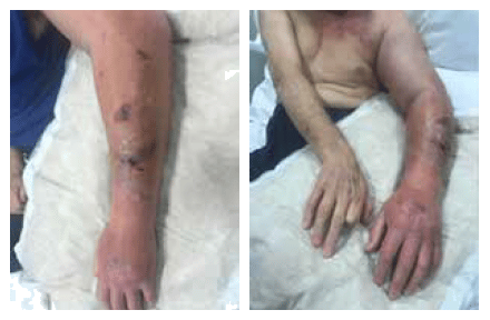 56-year-old male patient on haemodialysis for 5 years - Merit WRAPSODY