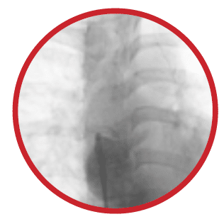 Fluoroscopy image showing Totally occluded superior vena cava